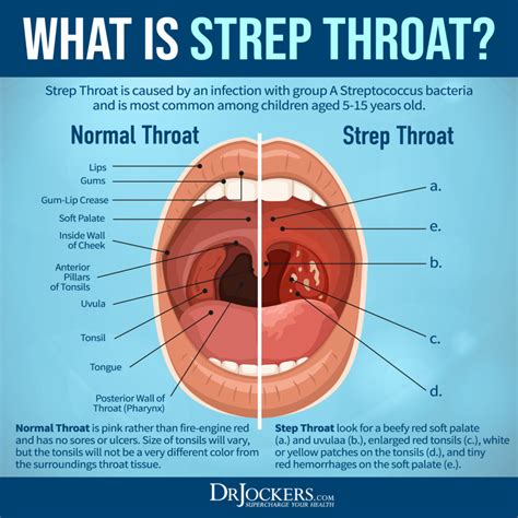 tumblr throat|What’s Going Around: Strep throat, bug bites .